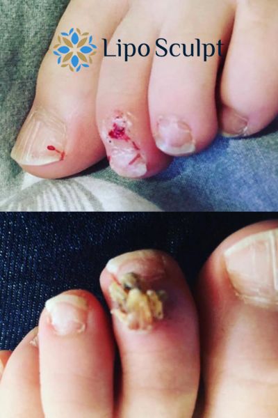 Wart removal customer results from Lipo Sculpt Bispham