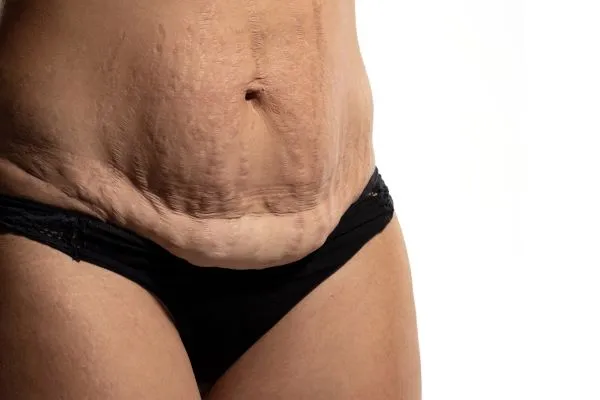 Lost the Weight but Not the Loose Skin? 1 image of womans stomach after weight loss showing loose skin Bispham